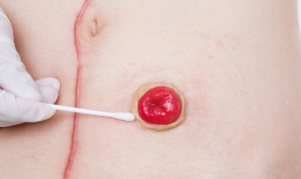 Stoma cilt bakımı ve günlük yaşam